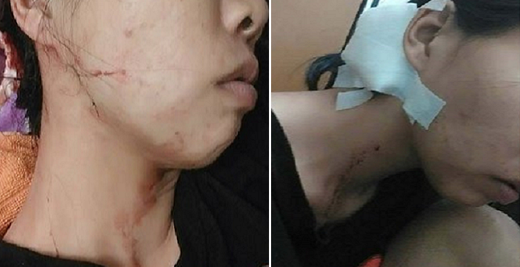 woman gets robbed and kicked by fake policemen in johor requires 8 stitches world of buzz