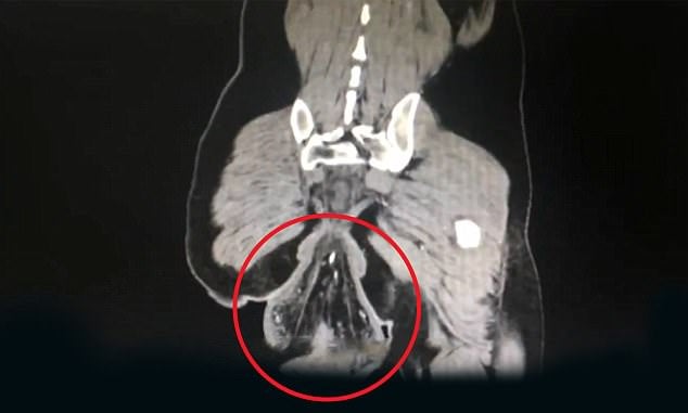 Man's Rectum Slips Out Anus After Sitting in Toilet For 30 Minutes - WORLD OF BUZZ