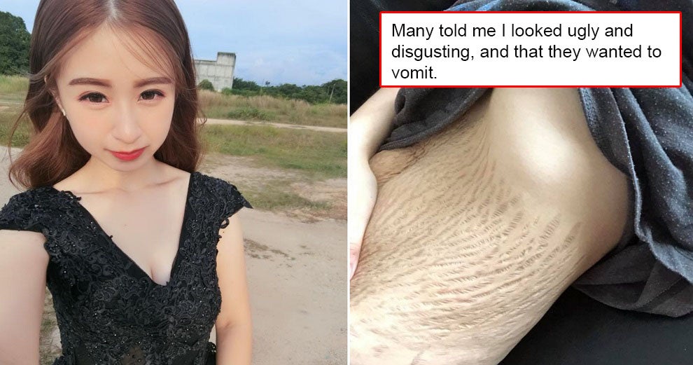 M'sian Mother of Quadruplets Attacked by Netizens After Sharing a Photo of Her Stretchmarks - WORLD OF BUZZ 4