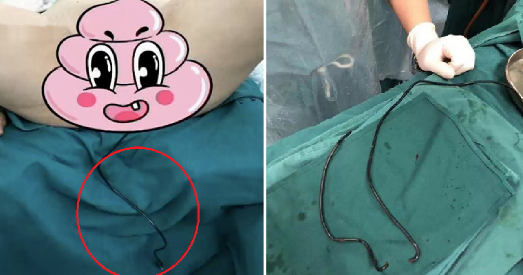 Man Hospitalised For Shoving 1M-Long Cable Into Penis To Scratch Raging Itch - World Of Buzz