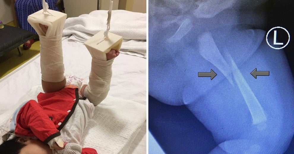 parents shocked to find their baby with broken thigh bone while allegedly under babysitters care world of buzz 3