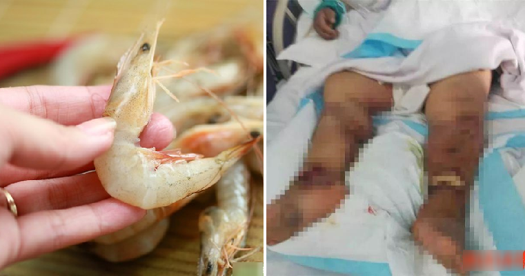 Woman Suffers Organ Failure and Dies After Accidentally Cutting Finger When Cleaning Shrimps - WORLD OF BUZZ 4