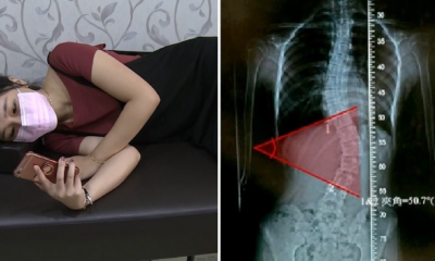 Young Girl Always Lies On Her Side To Play Her Phone, Develops 50 Degrees Curved Spine - World Of Buzz 2