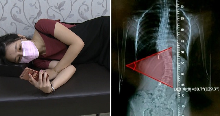 Young Girl Always Lies on Her Side to Play Her Phone, Develops 50 Degrees Curved Spine - WORLD OF BUZZ 2