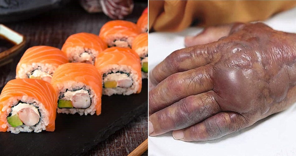 71Yo Man Hand Starts To Rot After Eating Sushi, Forced To Amputate Half Of His Arm - World Of Buzz