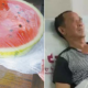 Man Has 70Cm Of Damaged Intestines After Eating Overnight Watermelon From Fridge - World Of Buzz 3