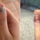20Yo Girl'S Bad Habit Of Biting Nails Exposed Her Skin To Infections, Now Has Cancer - World Of Buzz
