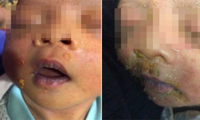 M'Sian Baby Contracted Highly Contagious Skin Disease From Infected Visitors At Hospital - World Of Buzz