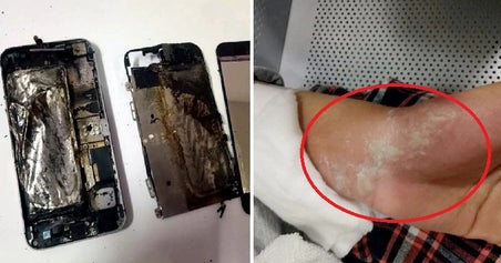 M'sian Girl Suffers Burns On Hand Due To Charging Phone Overnight - World Of Buzz 1
