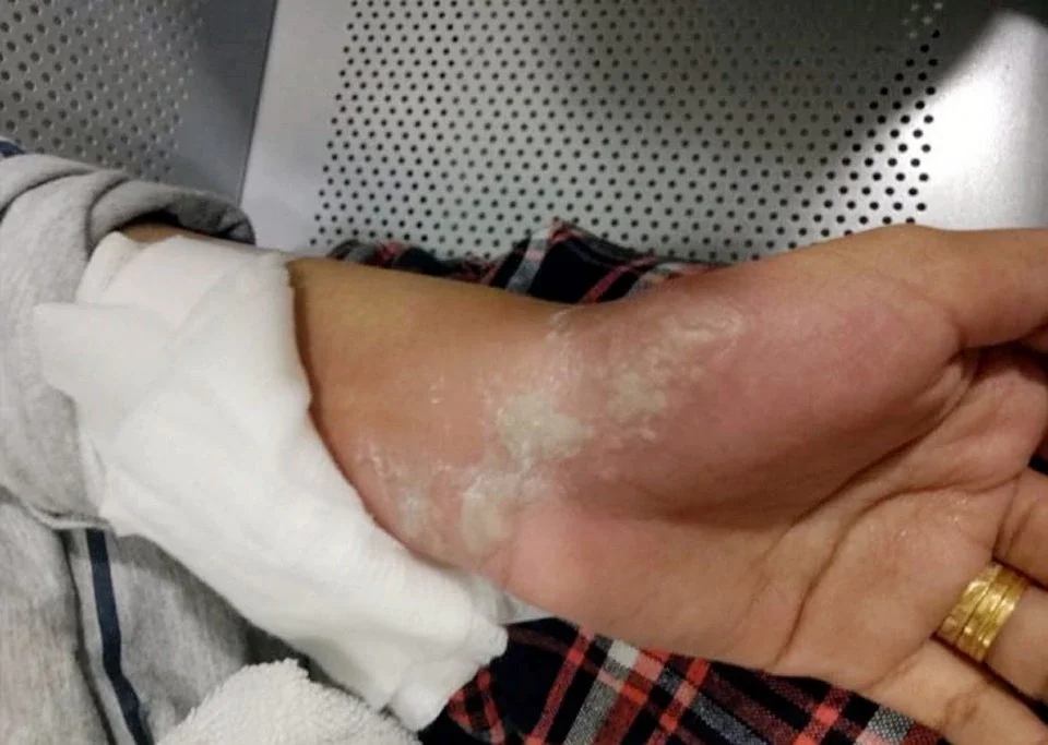 M'sian Girl Suffers Burns On Hand Due To Charging Phone Overnight - World Of Buzz