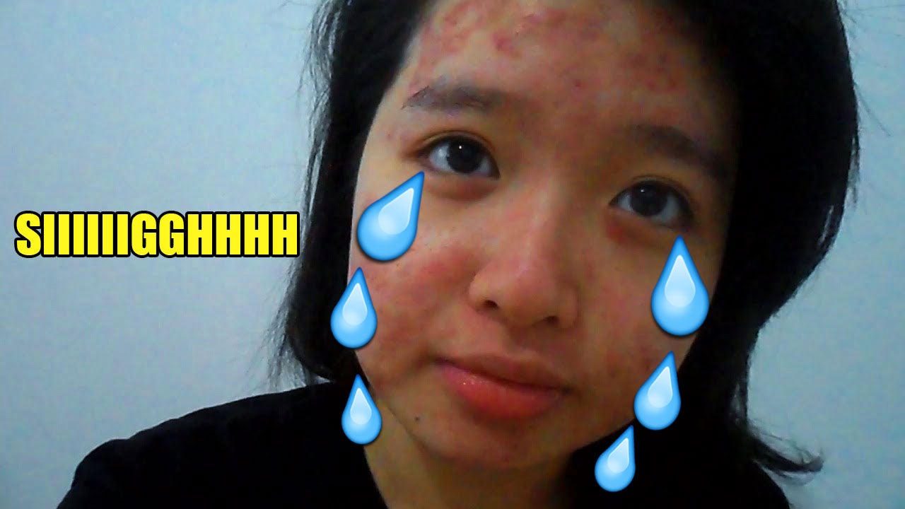 [TEST] 9 Real Struggles M'sians With Crazy Sensitive Skin Can Confirm Relate to - WORLD OF BUZZ