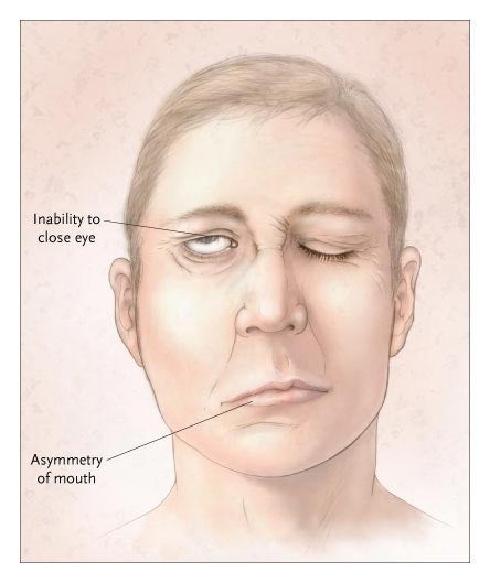 Stroke And Its Warning Symptoms weakness of face muscle