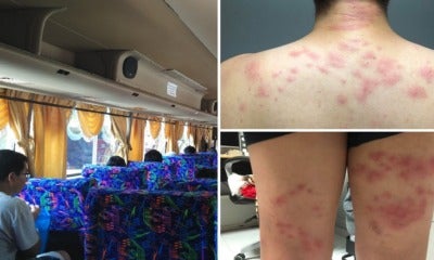 Another Passenger Suffers Severe Bedbug Bites While On Starmart Express Bus To Melaka - World Of Buzz 5