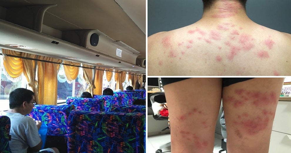 Another Passenger Suffers Severe Bedbug Bites While on StarMart Express Bus to Melaka - WORLD OF BUZZ 5