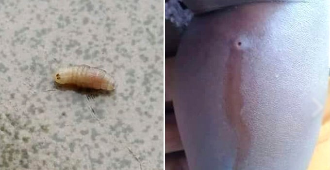 Mother Squeezes Out 'Pus' From Son's Body, Shockingly Turns Out to