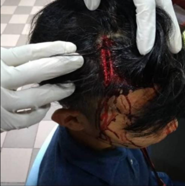Boy's Head Left Bloodied After Being Struck By Bicycle Part Thrown From Flat - WORLD OF BUZZ
