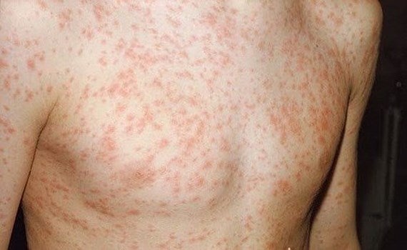 Travellers Advised to Get Vaccinated Before Going to Thailand Due to Measles Outbreak - WORLD OF BUZZ 1