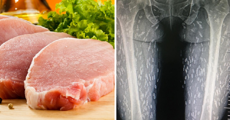 Woman's Love for Eating Raw Meat Causes Her Legs to Be Infected with Parasitic Worms - WORLD OF BUZZ 2