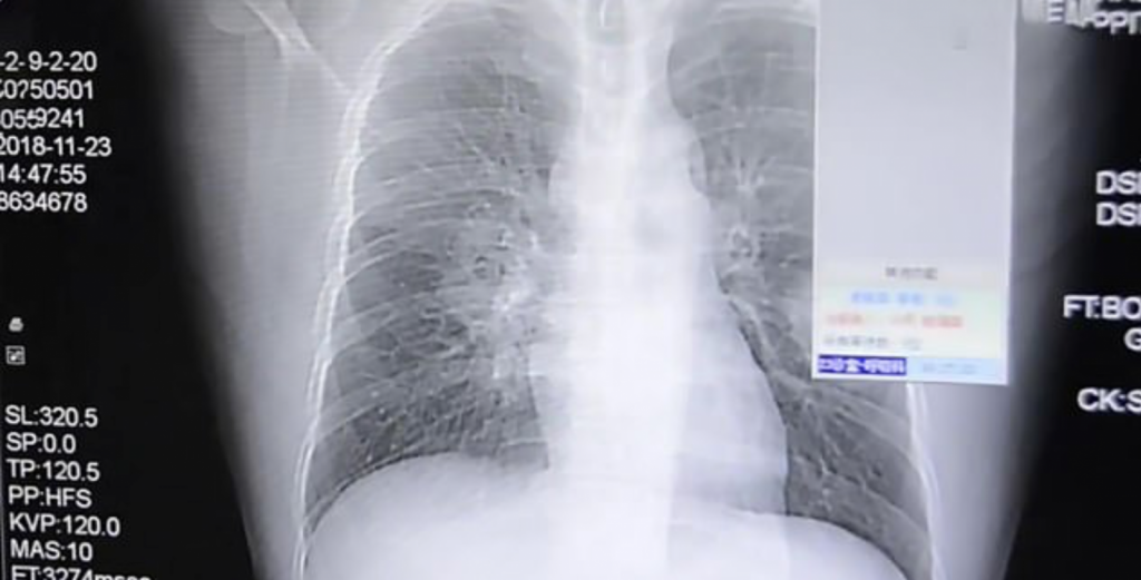 Man Developed Severe Fungal Infection In His Lungs After Sniffing His Smelly Socks Every Day - WORLD OF BUZZ 1