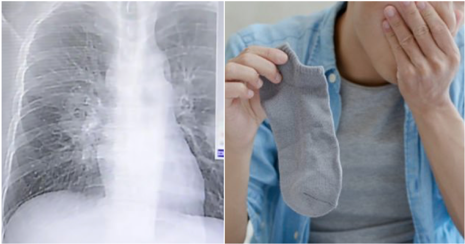 Man's Weird Habit Of Sniffing His Smelly Socks Caused Him To Develop Severe Fungal Infection In His Lungs - WORLD OF BUZZ