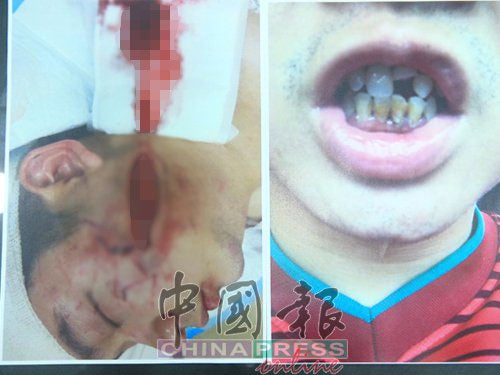 M'sian Man Gets Viciously Beaten Up In Kepong Bar For Saying &Quot;If You Can't Drink, Then Go Home&Quot; - World Of Buzz 5