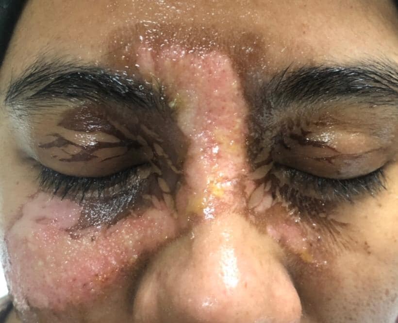 Woman Suffered 2nd And 3rd Degree Burns On Her Face After A Facial Spa Accident, Owner Refused To Be Responsible - WORLD OF BUZZ 2
