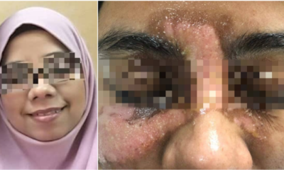 Woman Suffered 2Nd And 3Rd Degree Burns On Her Face After A Facial Spa Accident, Owner Refused To Be Responsible - World Of Buzz 3