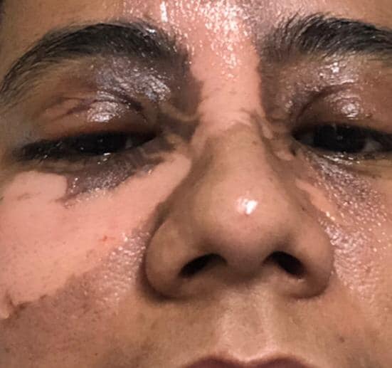 Woman Suffered 2Nd And 3Rd Degree Burns On Her Face After A Facial Spa Accident, Owner Refused To Be Responsible - World Of Buzz 4