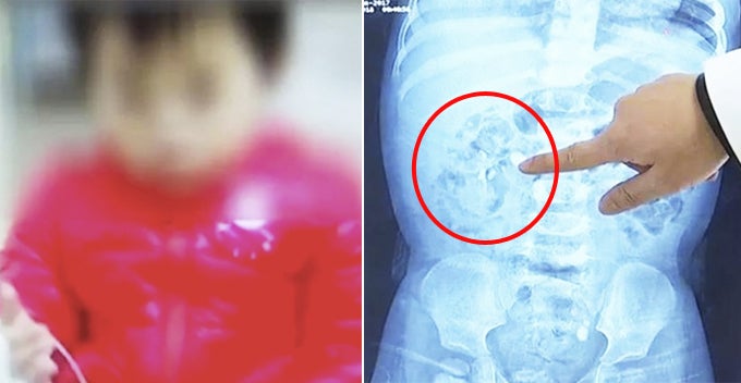 1Yo Baby Ends Up With Kidney Stones After Mother Gives Calcium Supplements To Boost Growth - World Of Buzz