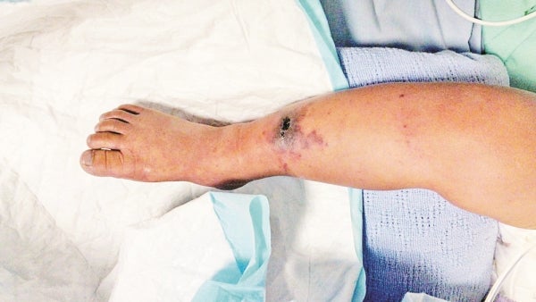 2yo Boy Risks Leg Amputation After Insect Bite on Leg Gets Infected with Flesh-Eating Bacteria - WORLD OF BUZZ 2