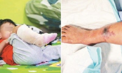 2Yo Boy Risks Leg Amputation After Insect Bite On Leg Gets Infected With Flesh-Eating Bacteria - World Of Buzz 4