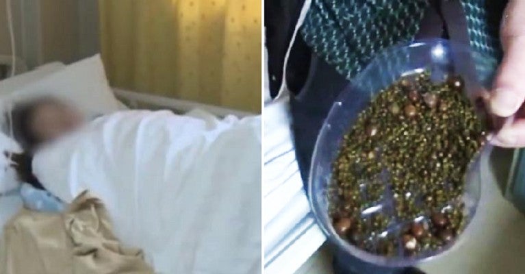 Doctors Remove Over 2,000 Gallstones from Woman Who Doesn't Eat Breakfast & Drinks Less Water - WORLD OF BUZZ 3