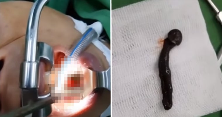 Surgeons Removing Woman's Throat Tumor Discover It's actually Huge 2-inch Leech. - WORLD OF BUZZ 1