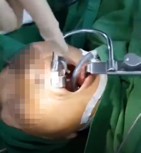 Surgeons Removing Woman's Throat Tumor Discover It's actually Huge 2-inch Leech. - WORLD OF BUZZ 2