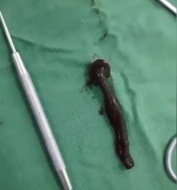 Surgeons Removing Woman's Throat Tumor Discover It's actually Huge 2-inch Leech. - WORLD OF BUZZ 3