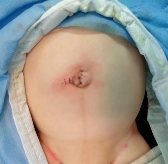 Baby's Intestines Spilled Out Of His Stomach After Father Made A Small Cut To Let Out Gas - World Of Buzz 2