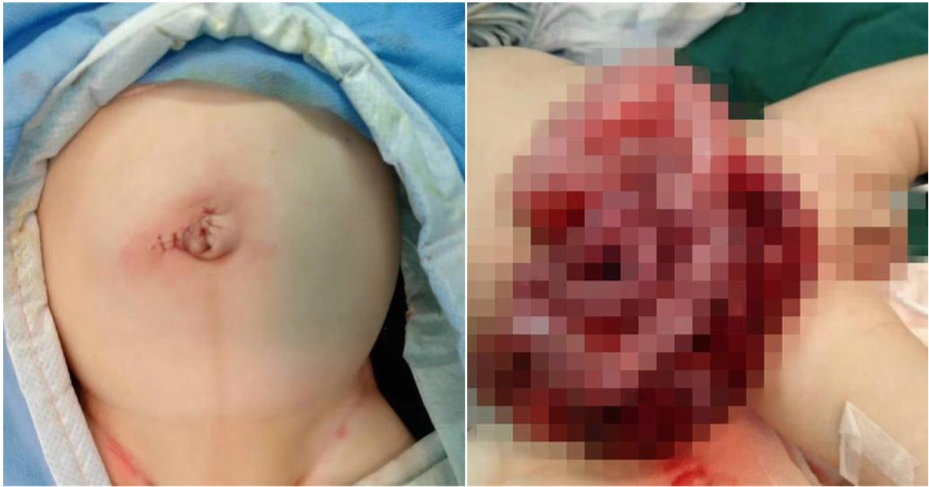 Baby's Intestines Spilled Out Of His Stomach After Father Made A Small Cut To Let Out Gas - WORLD OF BUZZ 4