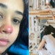 Girl Becomes Paralysed After Piercing Her Nose Due To Bacterial Infection - World Of Buzz