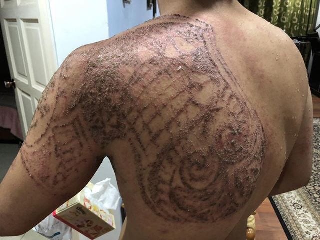 Malaysian Takes To Twitter To Warn Others After Henna Tattoo Burns Pattern Into His Skin - WORLD OF BUZZ 1