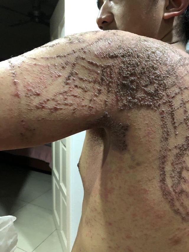 Malaysian Takes To Twitter To Warn Others After Henna Tattoo Burns Pattern Into His Skin - WORLD OF BUZZ 2