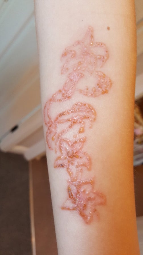 Malaysian Takes To Twitter To Warn Others After Henna Tattoo Burns Pattern Into His Skin - World Of Buzz 3