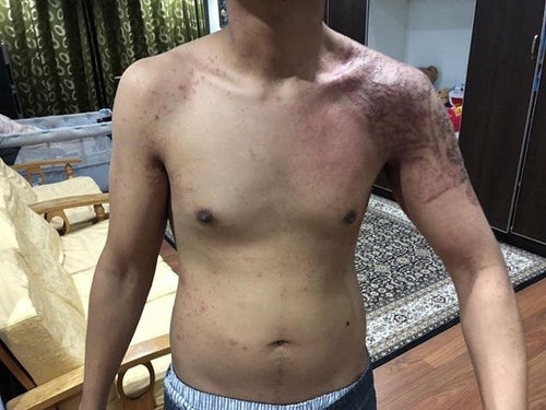 Malaysian Takes To Twitter To Warn Others After Henna Tattoo Burns Pattern Into His Skin - World Of Buzz