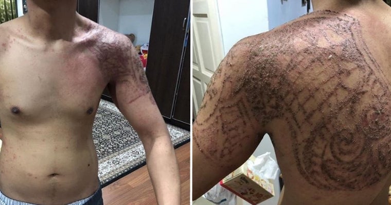 Msian Shares His Horrific Experience Using  'Halal Tattoo', Causing Severe &Quot;Burns&Quot; On Skin - World Of Buzz