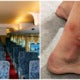 M'Sian Woman Takes Bus Ride To Singapore, Gets Blisters And Rashes From Bed Bugs - World Of Buzz