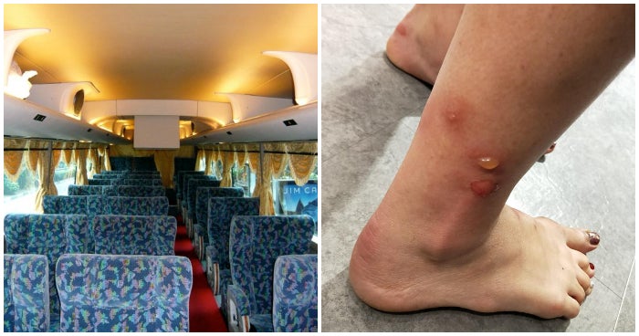 M'sian Woman Takes Bus Ride to Singapore, Gets Blisters and Rashes from Bed Bugs - WORLD OF BUZZ