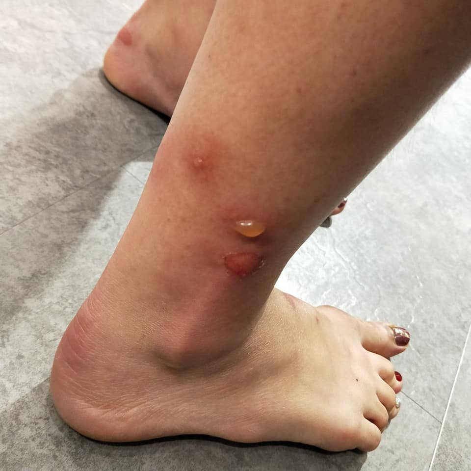 M Sian Suffers Painful Blisters Rashes From Bed Bugs After Taking Bus Ride To Singapore World Of Buzz