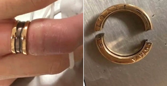Woman Receives Ring Worth Rm28,000 On Valentine'S, Had To Cut It Off As Finger Was Too Thick - World Of Buzz