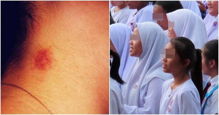 Mother Shocked To Find Hickey On 16yo Msians Neck Turns Out She Already Had Sex With 5 Guys