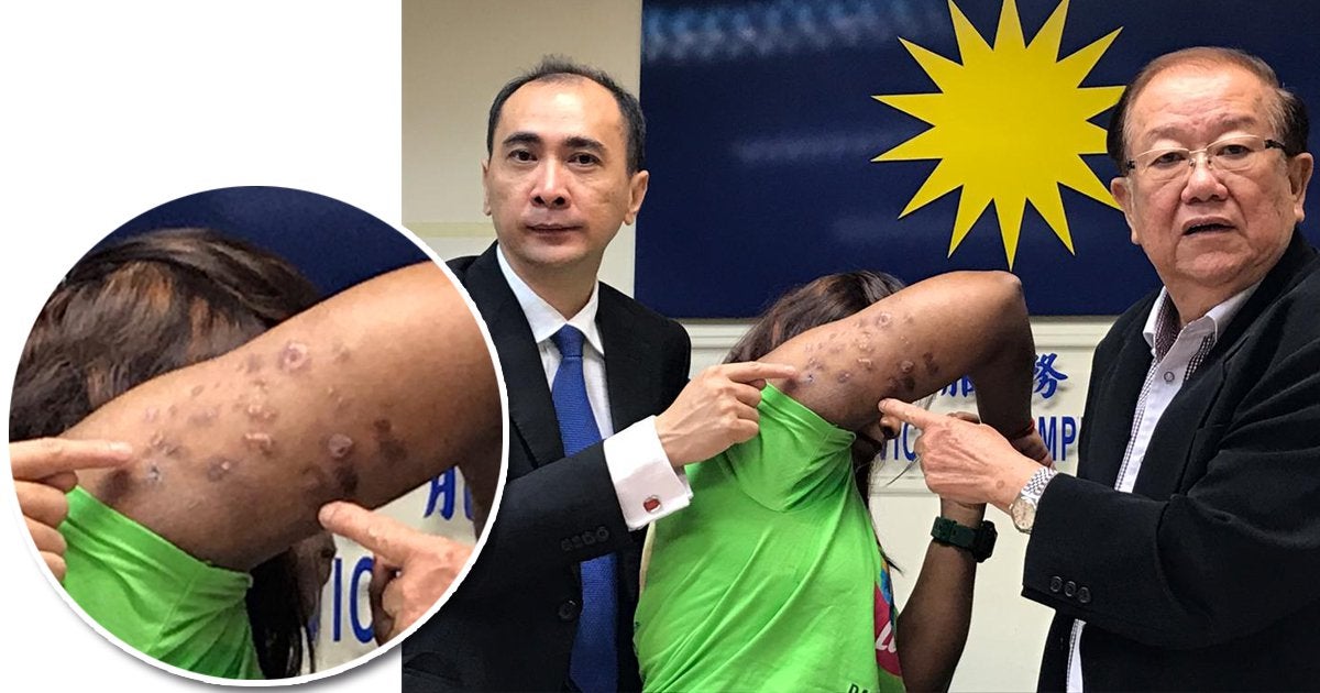 25yo M'sian Woman Gets Fat-Dissolving Injections for Arms, Ends Up with Major Bacterial Infection and Scars - WORLD OF BUZZ 1