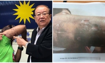 25Yo M'Sian Woman Gets Fat-Dissolving Injections For Arms, Ends Up With Major Bacterial Infection And Scars - World Of Buzz 6